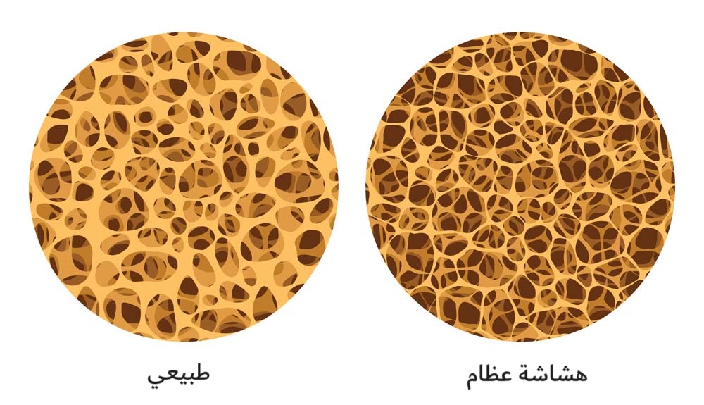 هشاشة العظام osteopororsis	