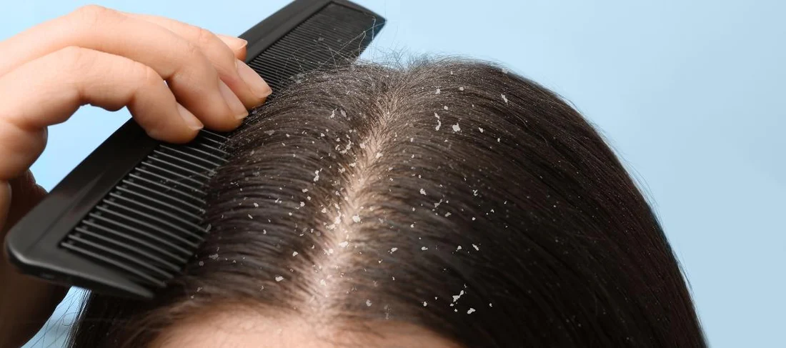 Dandruff قشرة الرأس	