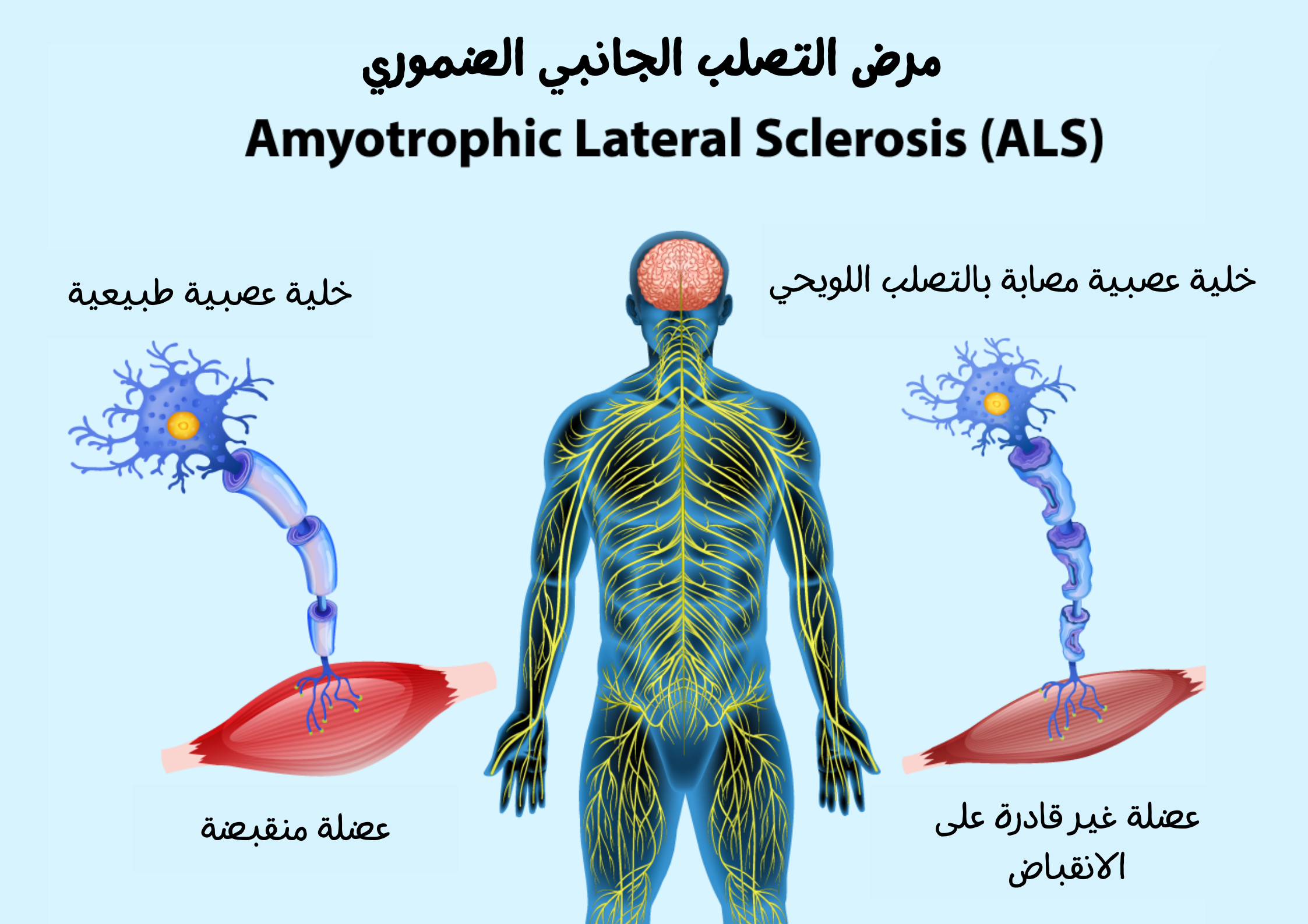 مرض التصلب الجانبي الضموري	