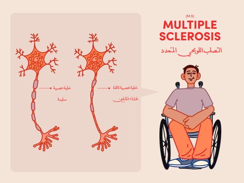 1a425718-898e-4838-9463-b6fd5cf49b7a_2024021420.jpg	multiple sclerosis التصلب اللويحي المتعدد