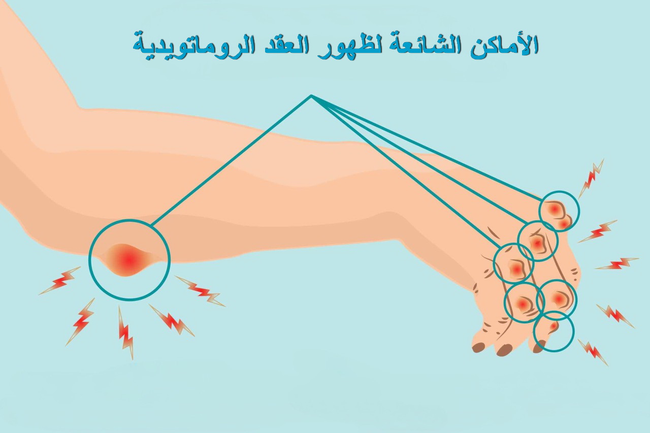 الأماكن الشائعة لظهور العقد الليمفاوية