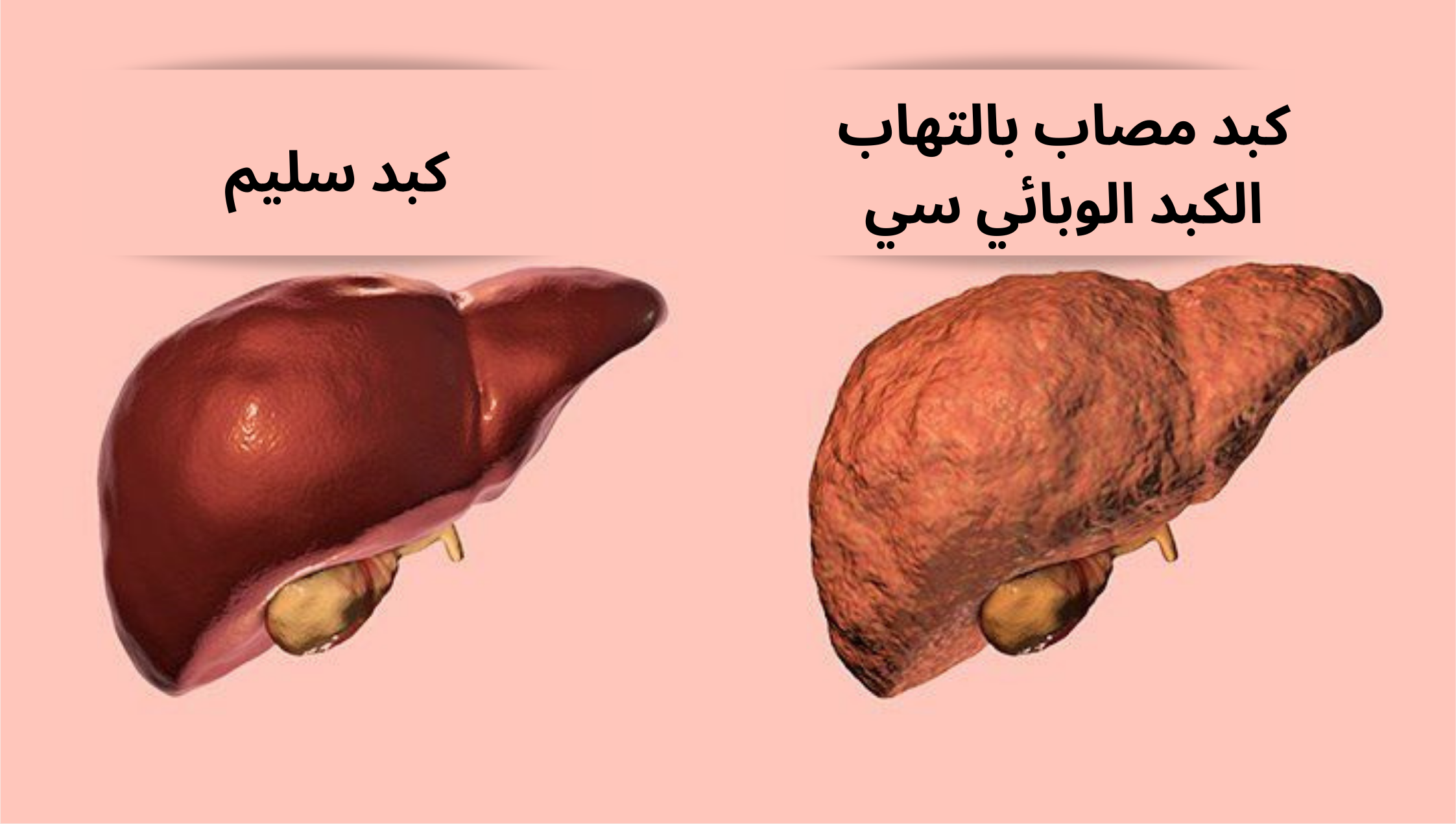 كبد مصاب بالتهاب الكبد الوبائي سي	