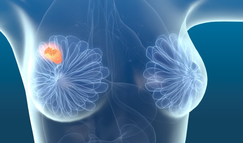 breast cancer سرطان الثدي	
