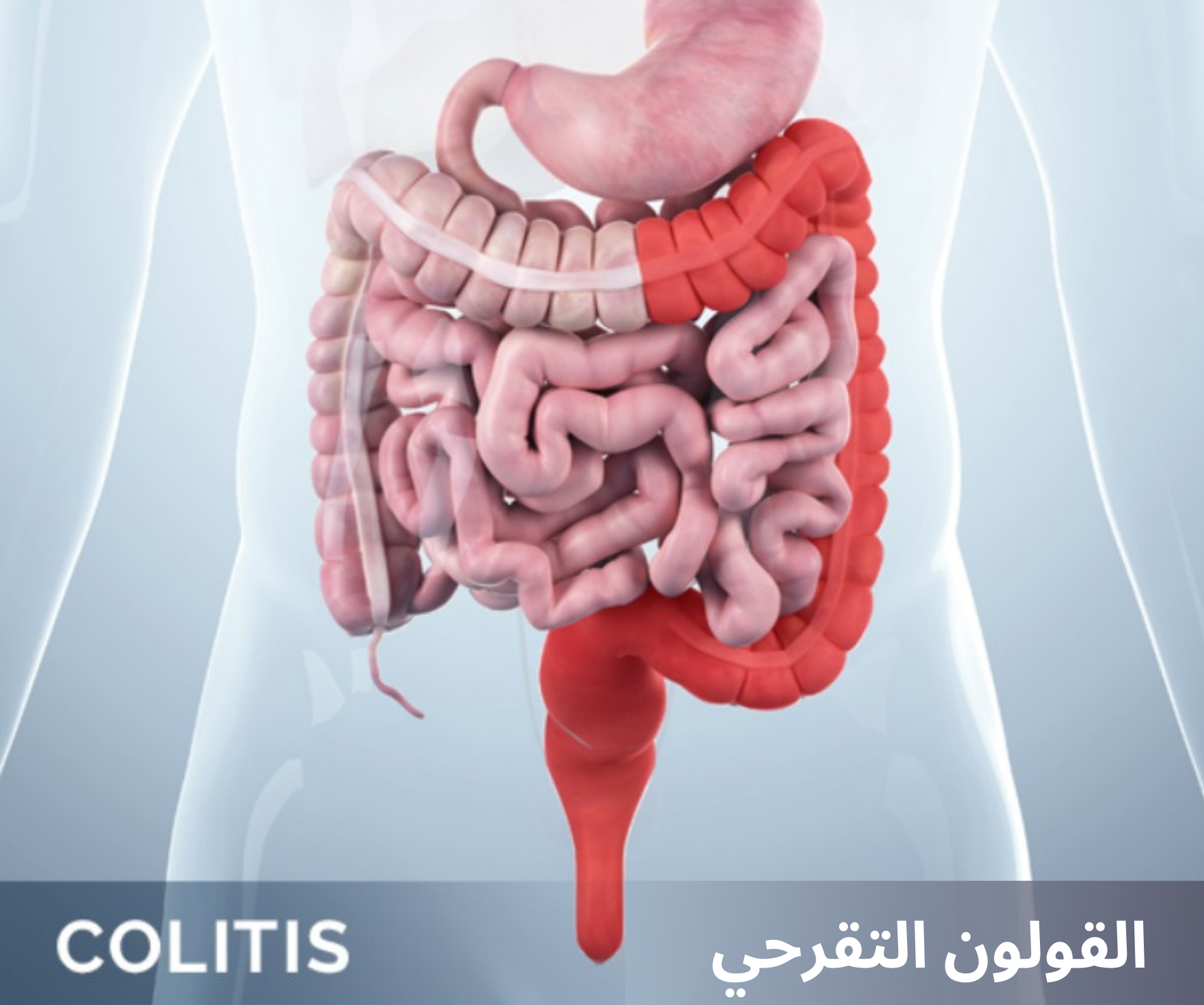 القولون التقرحي ulcerative colitis	