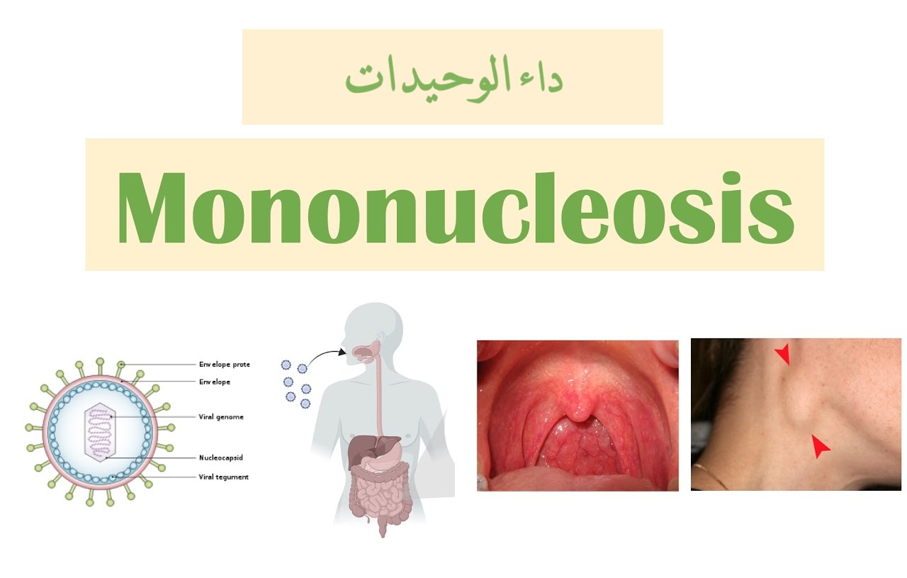 داء الوحيدات mononucleosis