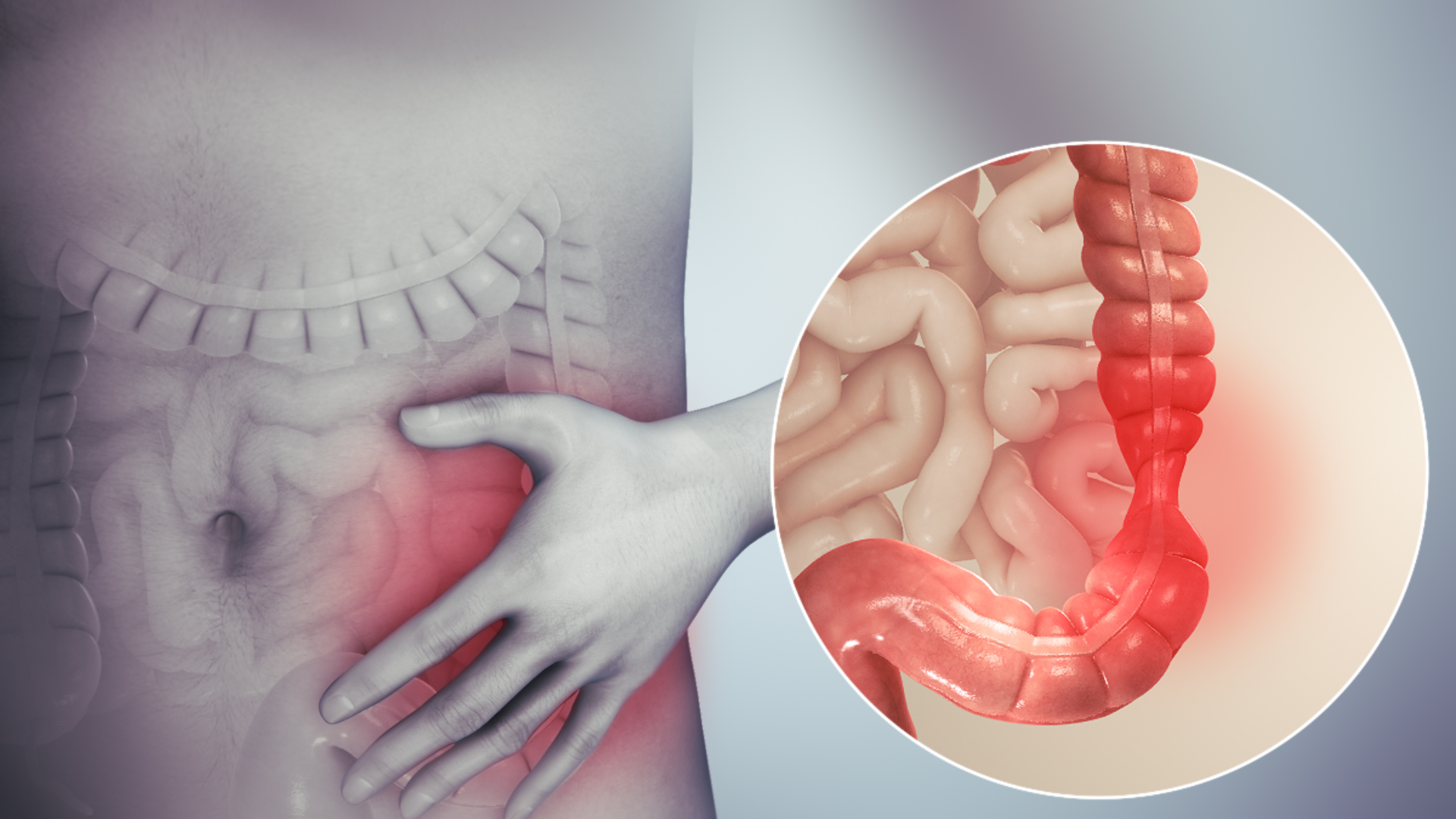 متلازمة القولون العصبي (Irritable Bowel Syndrome (IBS))