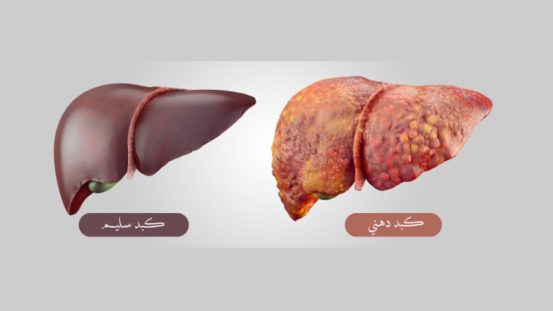 كبد دهني fatty liver	