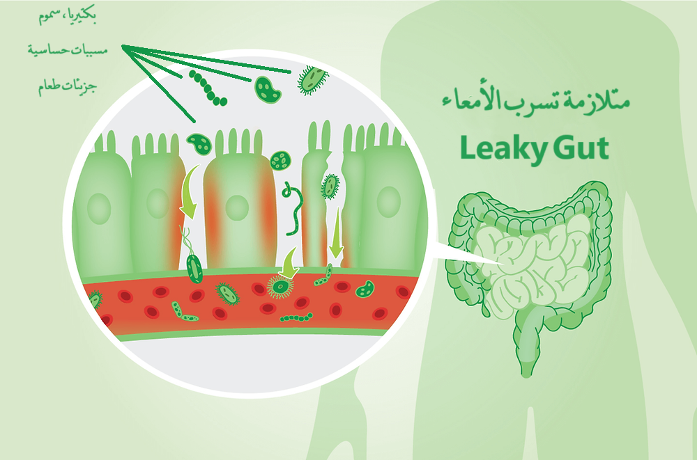 متلازمة تسرب الأمعاء LEAKY GUT	