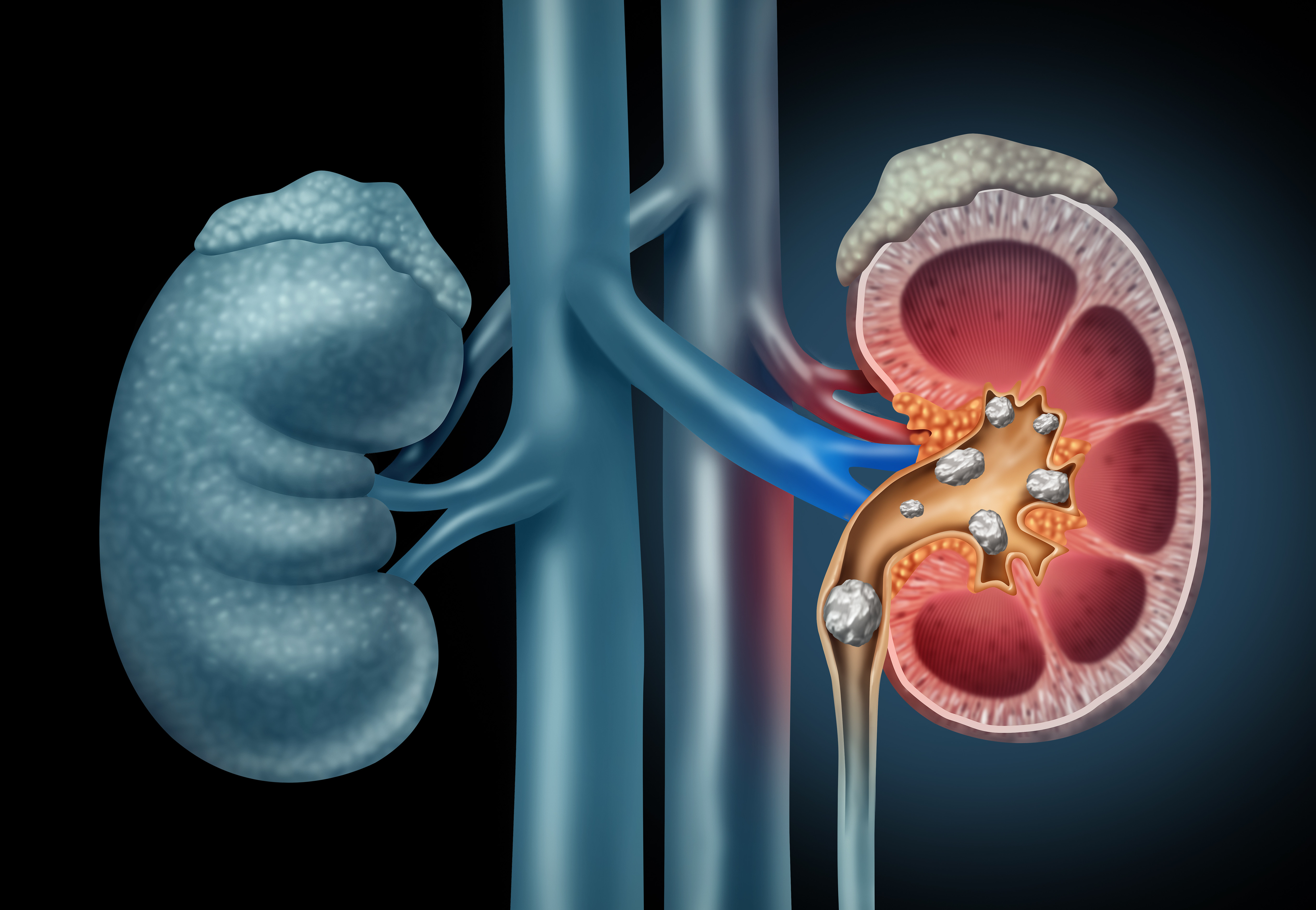 kidney stones حصوات الكلى	