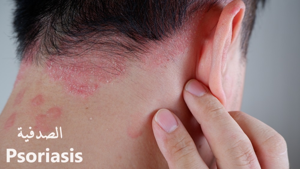 psoriasis الصدفية	