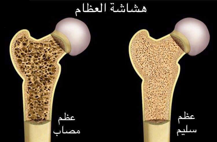 هشاشة العظام osteopororsis	