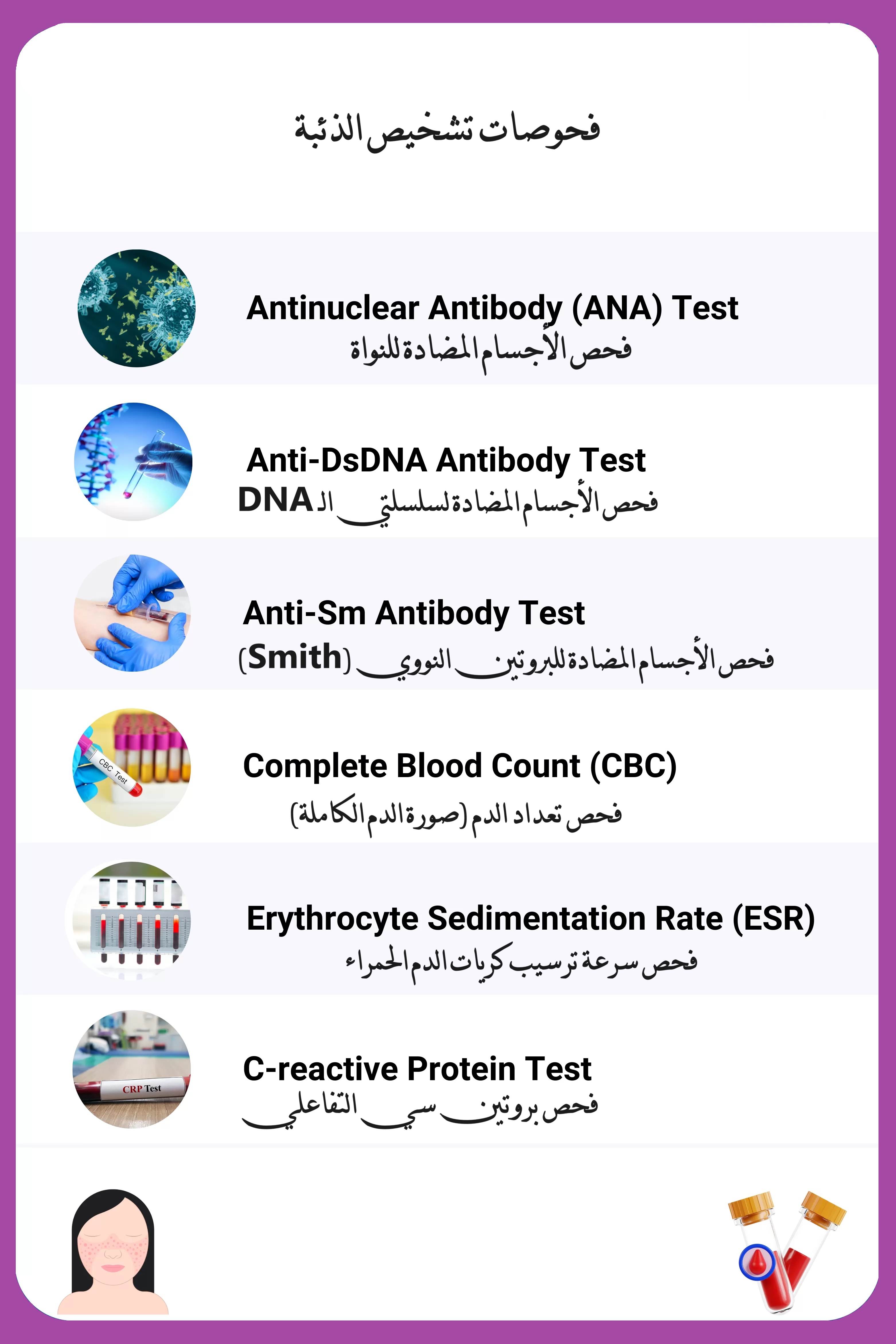 فحوصات تشخيص الذئبة