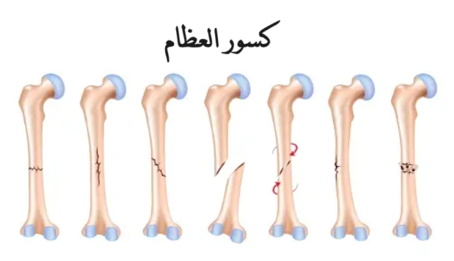 كسور العظام