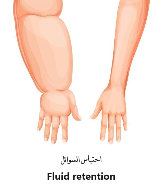 احتباس السوائل