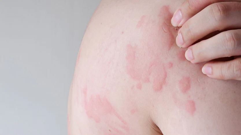 Urticaria الأرتيكاريا	