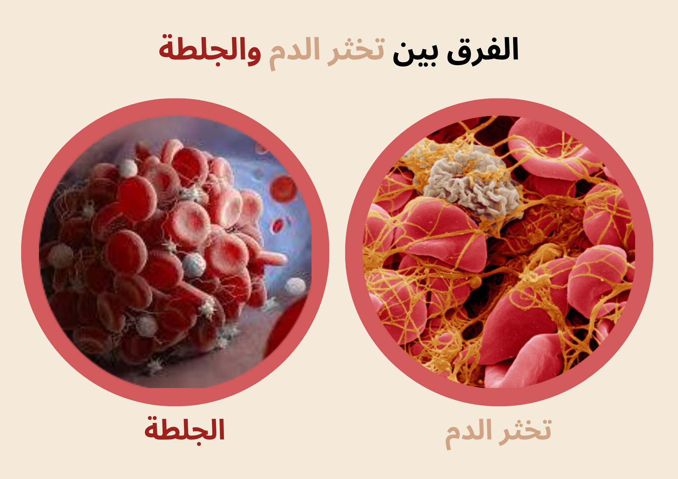 الفرق بين تخثر الدم والجلطة	