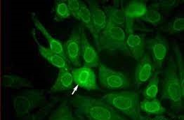 ana Antinuclear antibody	