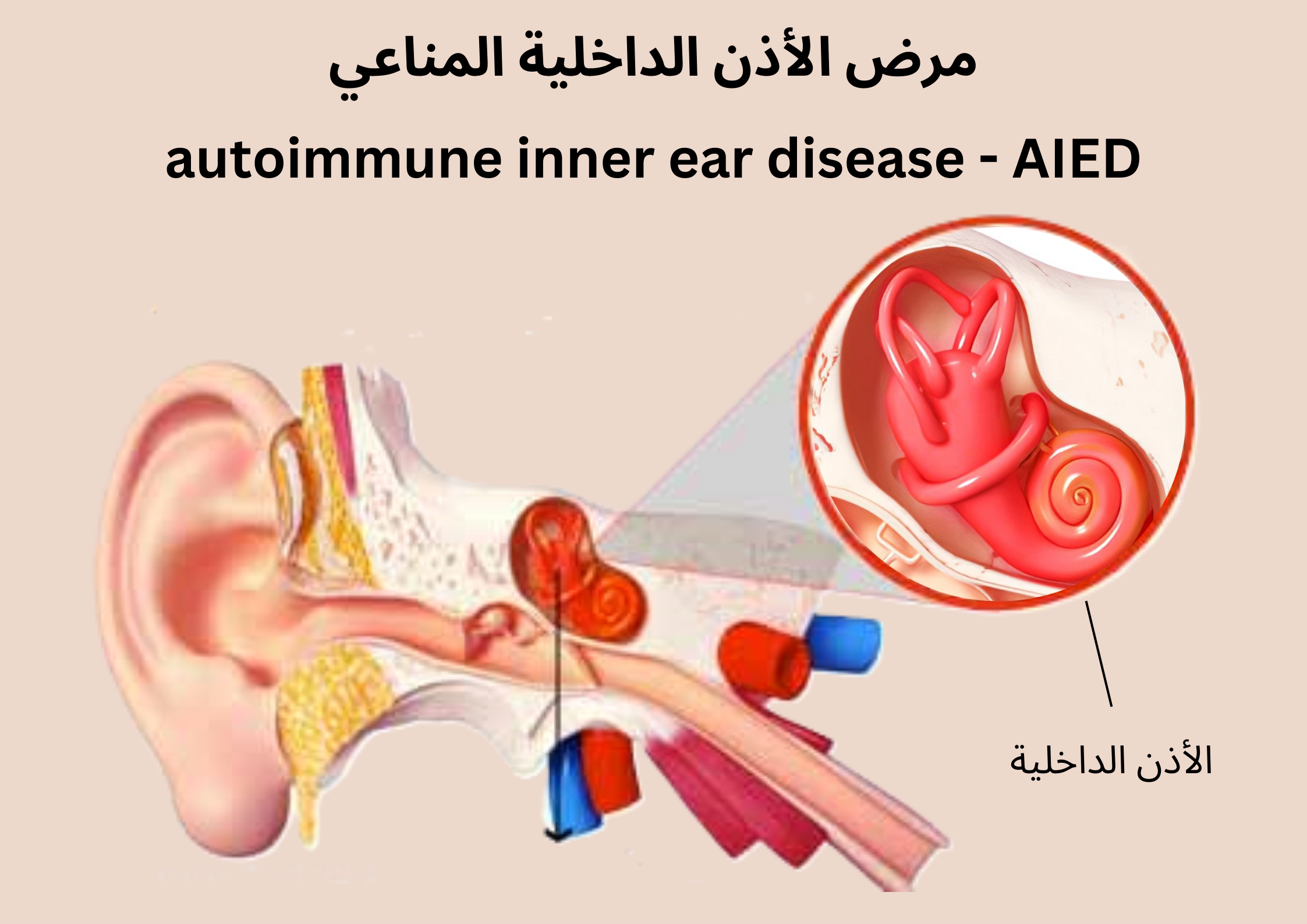 مرض الأذن الداخلية المناعي autoimmune inner ear disease - AIED	