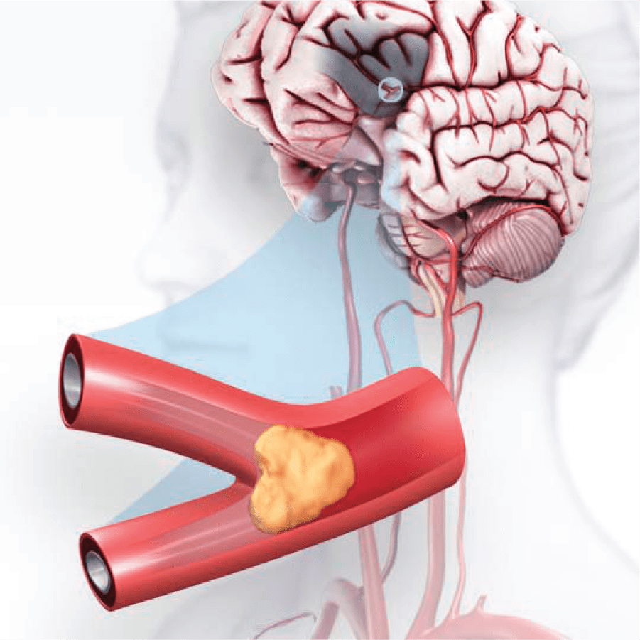 Strokes السكتة الدماغية	