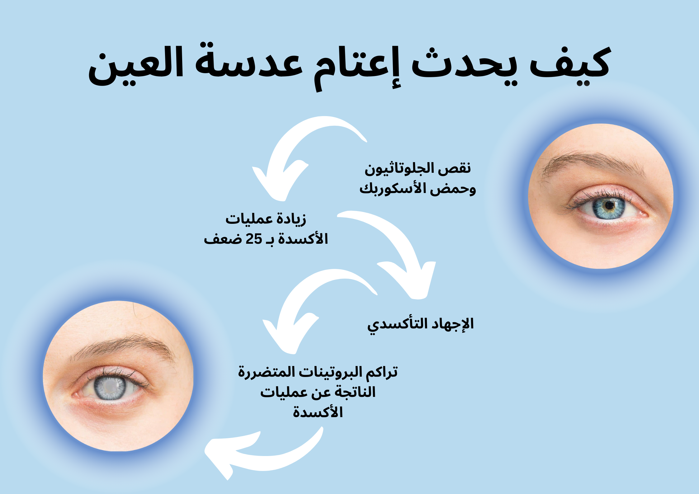 كيف يحدث إعتام عدسة العين	