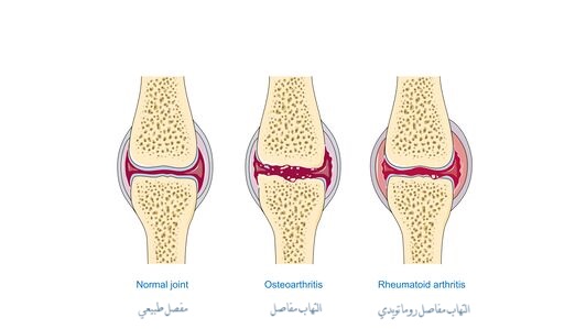 التهاب مفاصل osteoarthritis التهاب مفاصل روماتويدي	