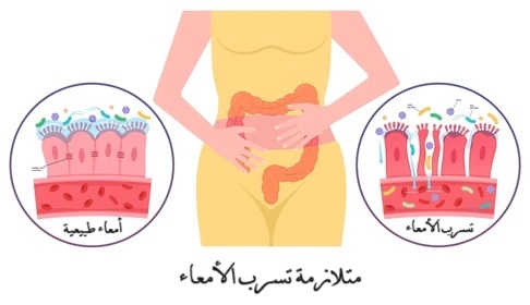 متلازمة تسرب الأمعاء LEAKY GUT	