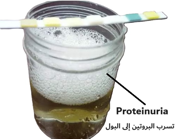 Proteinuria