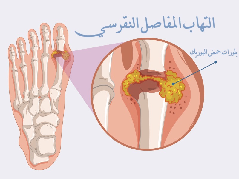 النقرس Gout التهاب المفاصل النقرسي	