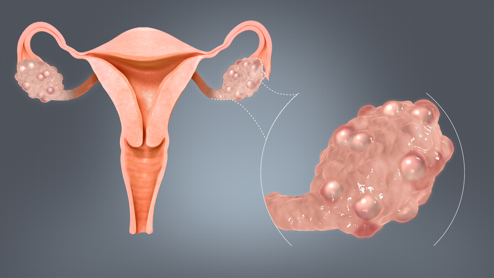 polycystic ovary syndrome متلازمة تكيسات المبايض	