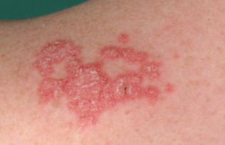 	Cutaneous lupus erythematosus الذئبة الحمراء الجلدية