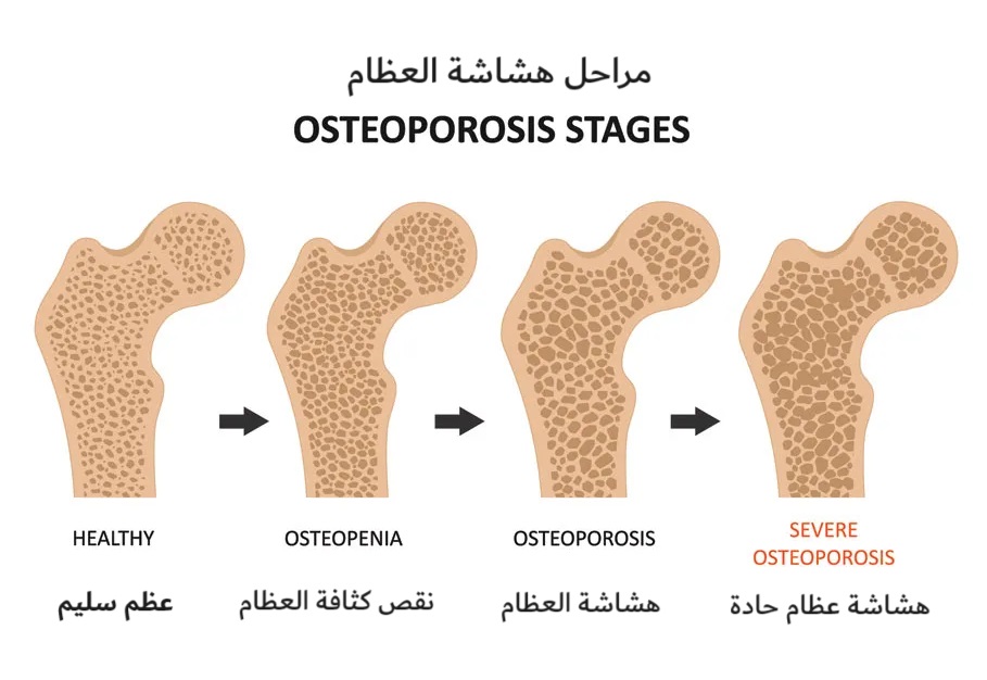 مراحل هشاشة العظام	